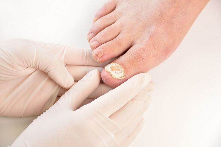 Před předepsáním léčby musí lékař diagnostikovat houbu nehtů