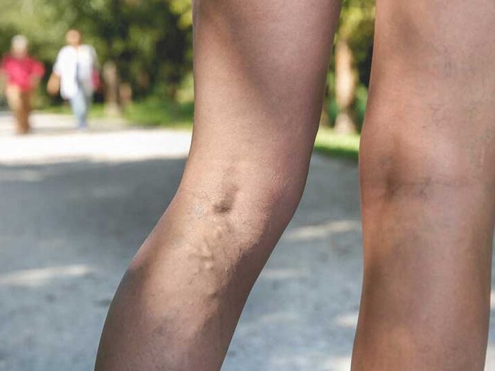 Křečové žíly jsou rizikovým faktorem pro infekci plísní nohou