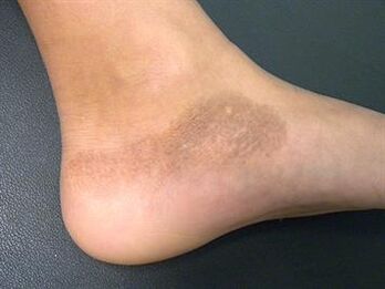 Mykóza nohou je doprovázena změnou odstínu kůže