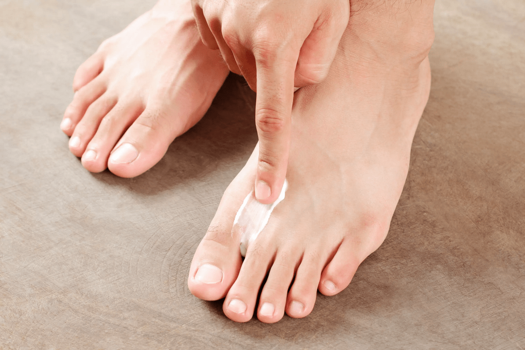 aplikace antifungální masti na kůži nohy