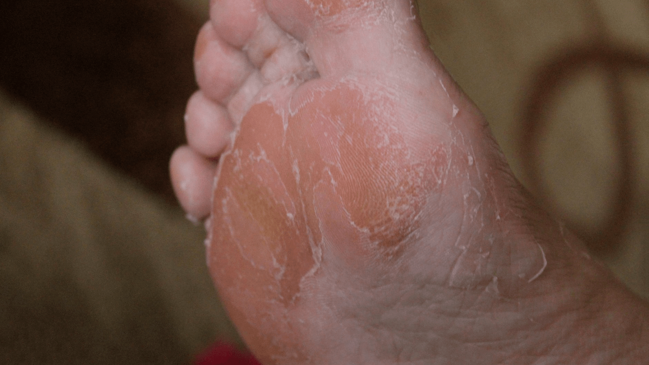 plíseň kůže nohou