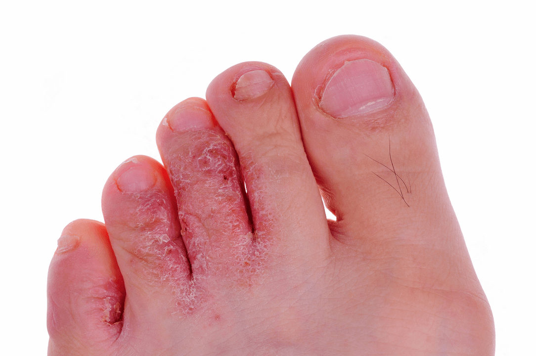 plísňová infekce kůže mezi prsty na nohou