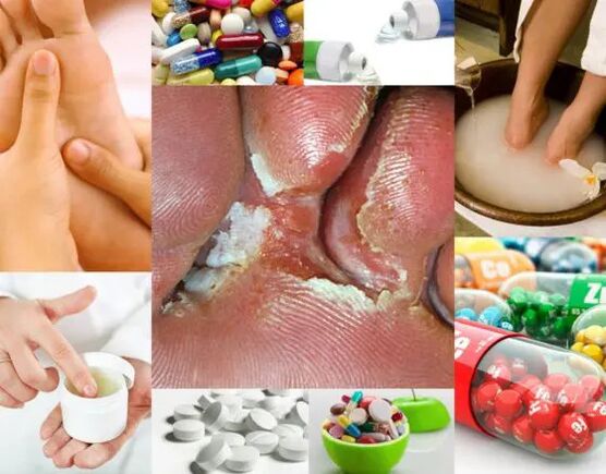 Interdigitální mykóza a metody léčby